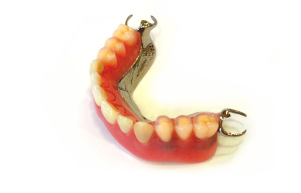 入れ歯の種類・金属の部分義歯