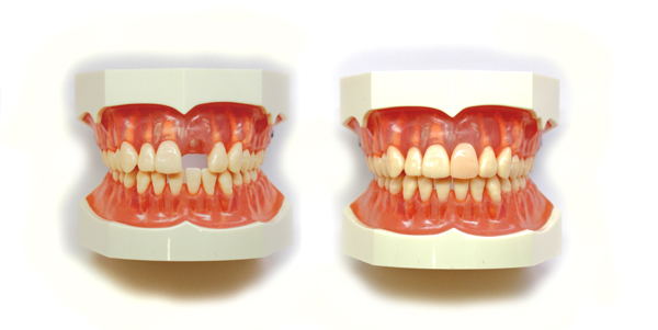 歯を削らずに接着でつけるブリッジ