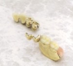 アタッチメントとブレードの入れ歯