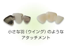 ウイングアタッチメント・部分入れ歯